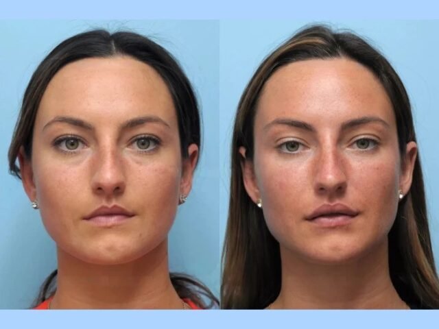 Customized Thread Lift Treatment in Dubai for Facial Rejuvenation