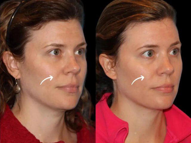 Best Aesthetic Clinics in Dubai Explore Sculptra Fillers for Smile Line Depth
