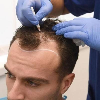 Hair Transplant in Dubai: Improving Thin Areas with Targeted Restoration