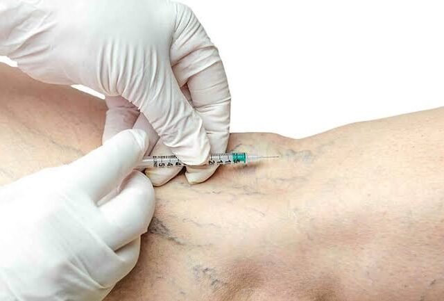 Sclerotherapy in Dubai: Exploring Treatment Options for Visible Veins